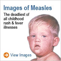 Images of Measles: The deadliest of all childhood rash and fever illnesses