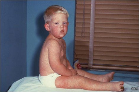 Measles image