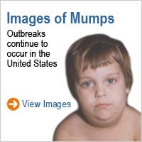 Images of Measles: Outbreaks continue to occur in the United States