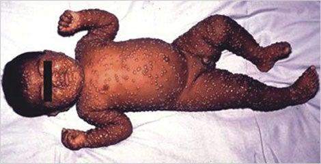Heat Rash or Prickly Heat (Miliaria Rubra) in an Infant or ...