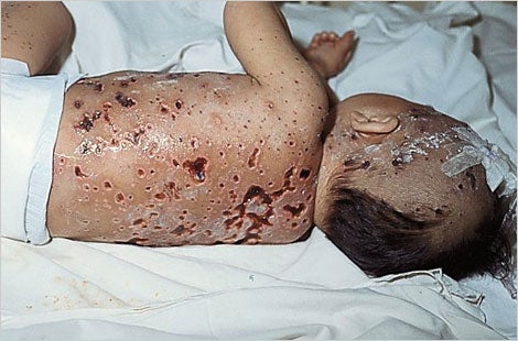 chicken pox rash image #11
