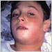 10-year-old child with severe diphtheria