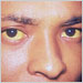 Hepatitis A is manifested here as icterus, or jaundice of the conjunctivae and facial skin