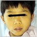 Hepatitis A infection in a child