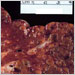 Section of liver damaged by HBV. Note the enlarged cells and blistering of the capsular surface.