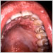 This HIV-positive patient was exhibiting signs of a secondary condyloma acuminata infection, i.e., venereal warts.