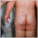 Characteristic red blotchy rash on child's buttocks and back during third day of the measles rash