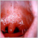 Measles (rubeola) pharyngitis in an adult showing striking inflammation