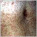 Extensive measles rash