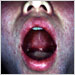 Koplik spots, blue-white spots on the inside of the mouth that occur 24-48 hours before the rash stage