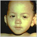 Child in later stages of measles rash