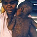 Late 1960s photograph shows a Nigerian mother and her child who was recovering from measles; note that the skin is sloughing on the child as he heals from his measles infection.