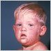 Face of boy with measles