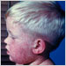 Head and shoulders of boy with measles