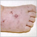 Characteristic angular, necrotic lesions on the foot of infant with meningococcemia