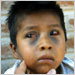 Child with broken blood vessels in eyes and bruising on face due to pertussis coughing