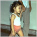 Child with a severely deformed leg due to polio