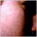 Rubella rash (face) in a previously unimmunized young woman