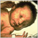 Infant with congenital rubella syndrome