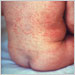 Rash of rubella on skin of child's back