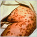 Close-up of smallpox lesions on a person's leg
