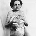 Woman with smallpox