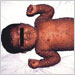 Infant with smallpox