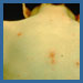 Image of boy with chickenpox
