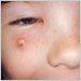 Girl with secondary skin infection due to chickenpox