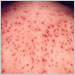 30-year-old female with acute chickenpox infection (view of back)