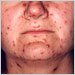 30-year-old female with acute chickenpox infection (view of face)