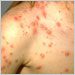 Adolescent female with varicella lesions in various stages