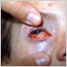 Varicella with scleral lesions and bulbar conjunctivitis