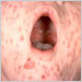Child with varicella lesions on the palate