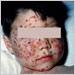 Varicella in a child with recent group A streptococcal pharyngitis