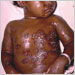 Child with superinfected varicella lesions