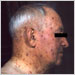 Elderly man with chickenpox