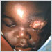 Infant with necrotizing fasciitis, a complication of varicella