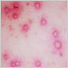 Chickenpox lesions on the skin