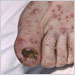 Left foot of elderly man with chickenpox