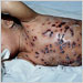 Chickenpox, hemorrhagic