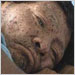 Arawete Indian man with chickenpox (Brazil)
