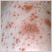 Left shoulder region of elderly man with chickenpox