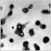 Transmission electron micrograph of varicella-zoster virions from vesicle fluid of patient with chickenpox