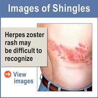 Images of Zoster (shingles) disease