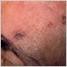 These skin lesions on the forehead of an elderly woman are due to the herpes zoster virus on the 21st day of the illness