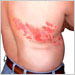 Shingles is a painful rash, consisting of red patches of skin with small blisters (vesicles) that look very similar to early chickenpox