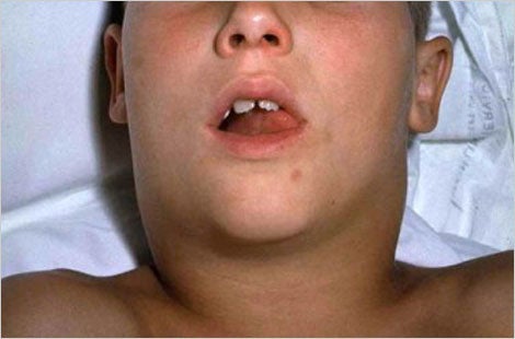 Diphtheria-Causes-Symptoms-Diagnosis-Best treatment-Homeopathy-Dr-Qaisar-Ahmed