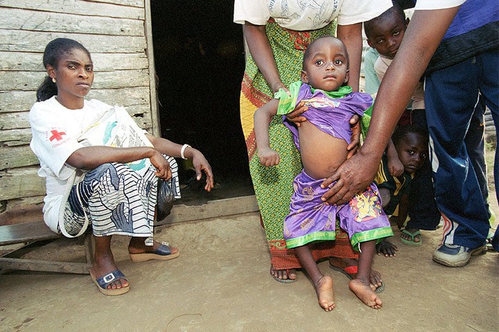 Polio Images | Immunize.org