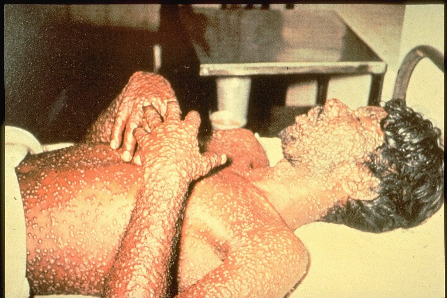 Smallpox Images | Immunize.org